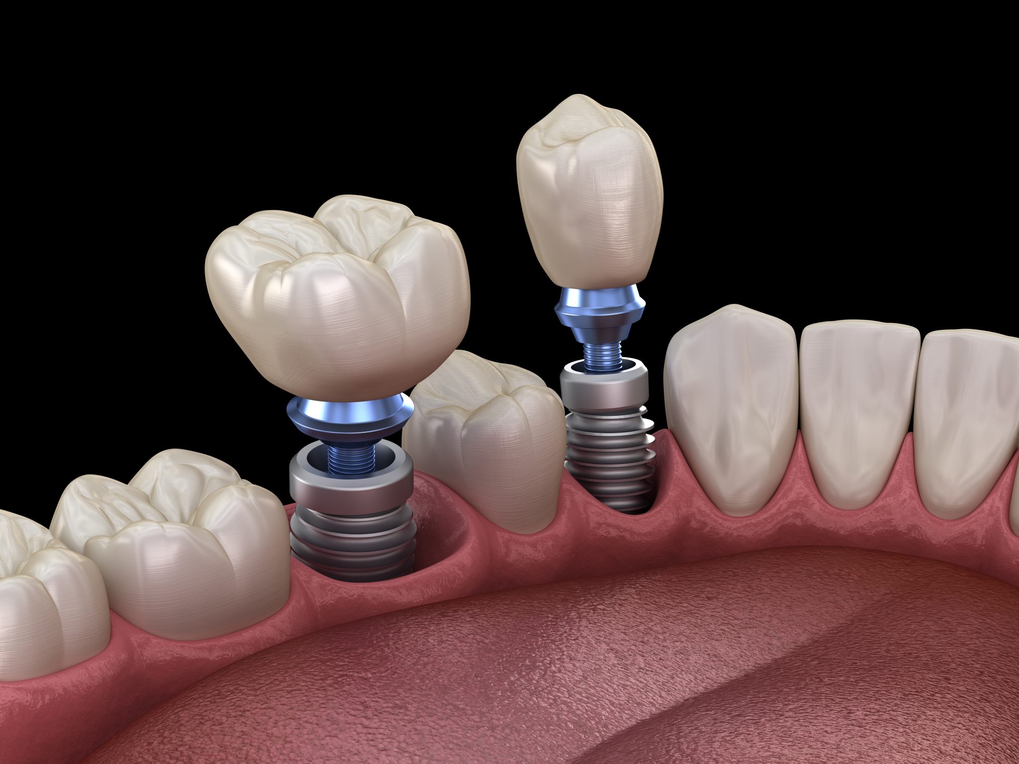How Often do Dental Implants Need to Be Replaced? | Coastal Dental Arts