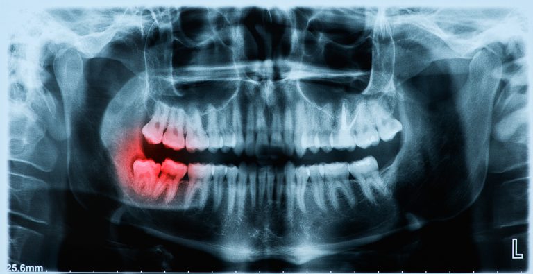 Panoramic X Ray Image Of Teeth And Mouth With Wisdom Teeth