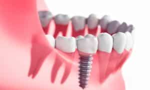 dental implants peabody coastal dental arts peabody dentist dr peter brzoza dds ficoi