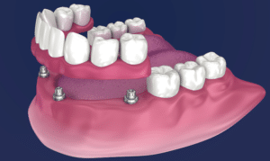 how implant overdentures can restore your bite functionality