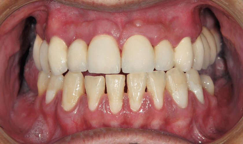 breaking down the myths debunking misconceptions about full mouth reconstructions
