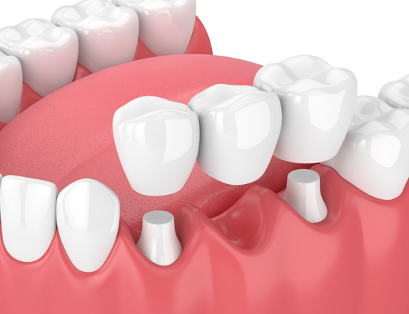 Dental Implant with Dental Bridges