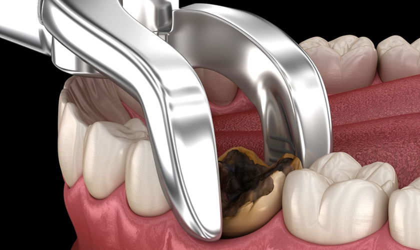 what to expect during tooth extraction a step-by-step guide