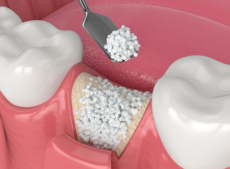 bone grafting peabody
