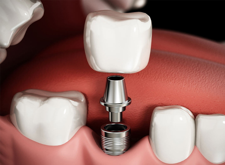 dental implants peabody