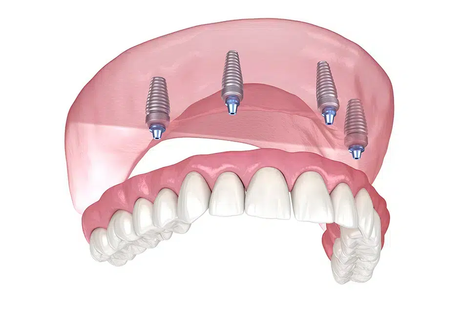 full arch dental implants peabody