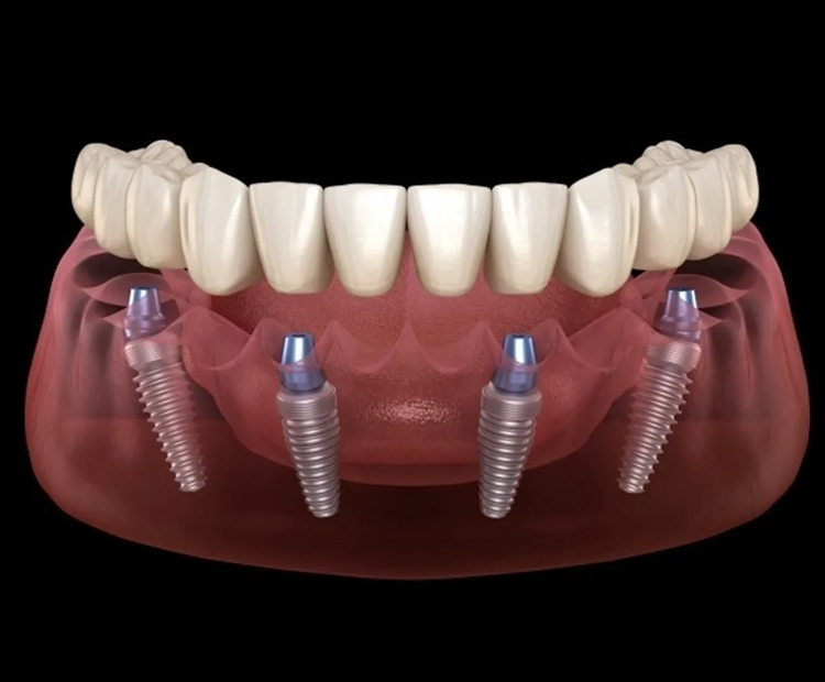 full mouth implant reconstruction peabody