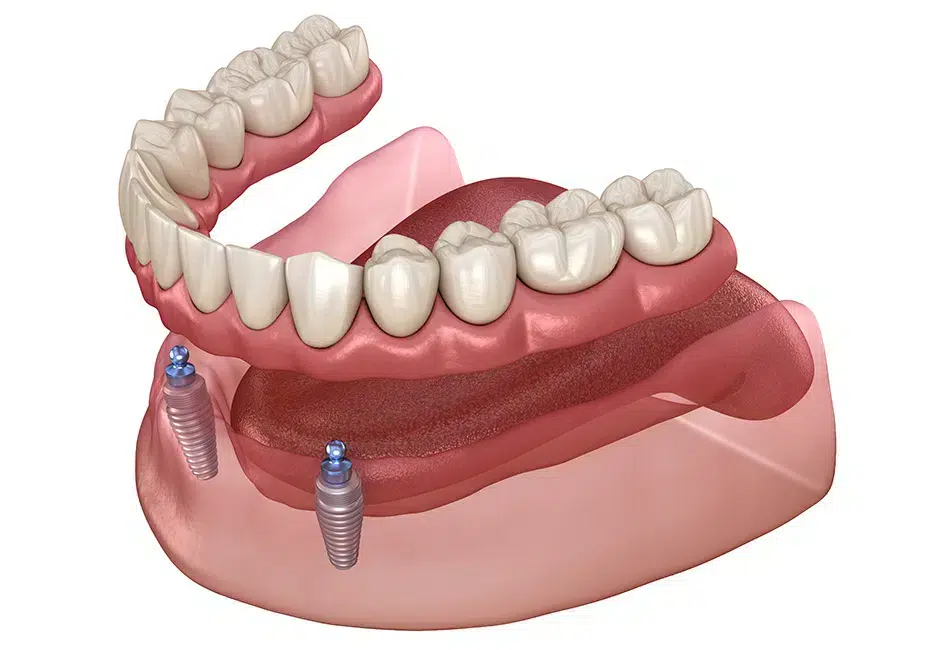 overdenture peabody
