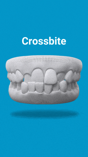 crossbite