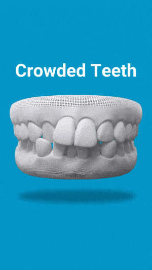 crowded teeth