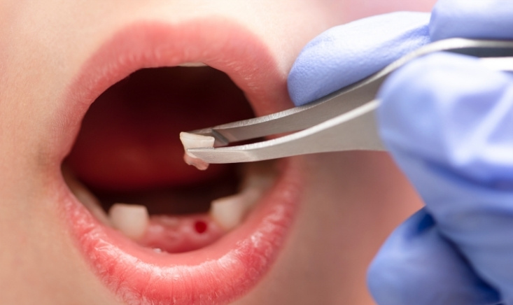 natural ways to support healing after a tooth extraction