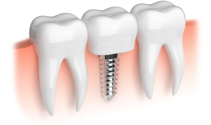 how sinus grafting supports successful dental implants
