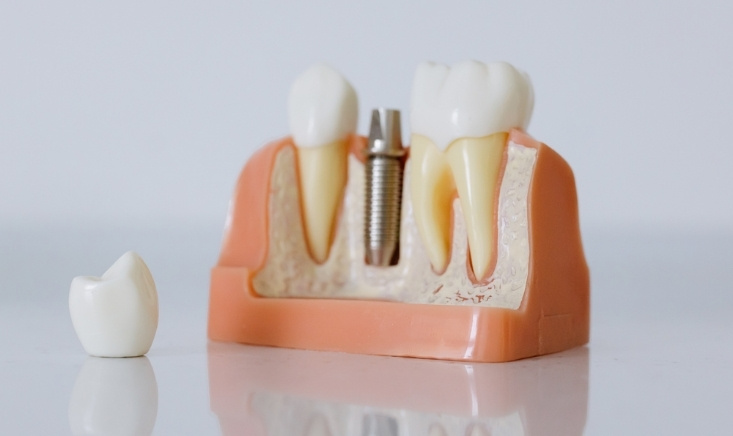 can dental implants improve your face shape