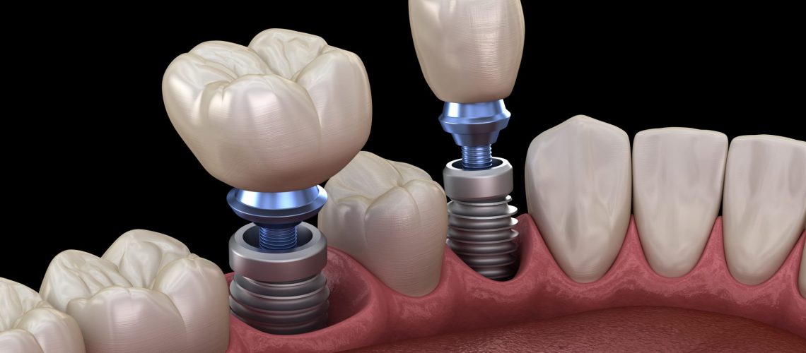Premolar And Molar Tooth Crown Installation Over Implant Concept. 3d Illustration Of Human Teeth And Dentures