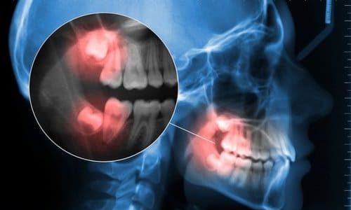 cephalometric and displaying toothache wisdom tooth